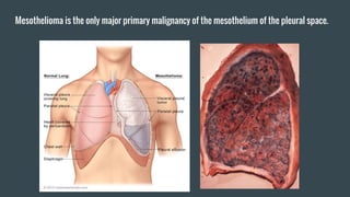 Mesothelioma is the only major primary malignancy of the mesothelium of the pleural space.
 