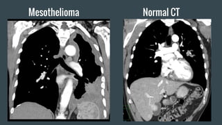 Mesothelioma Normal CT
 