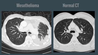 Mesothelioma Normal CT
 