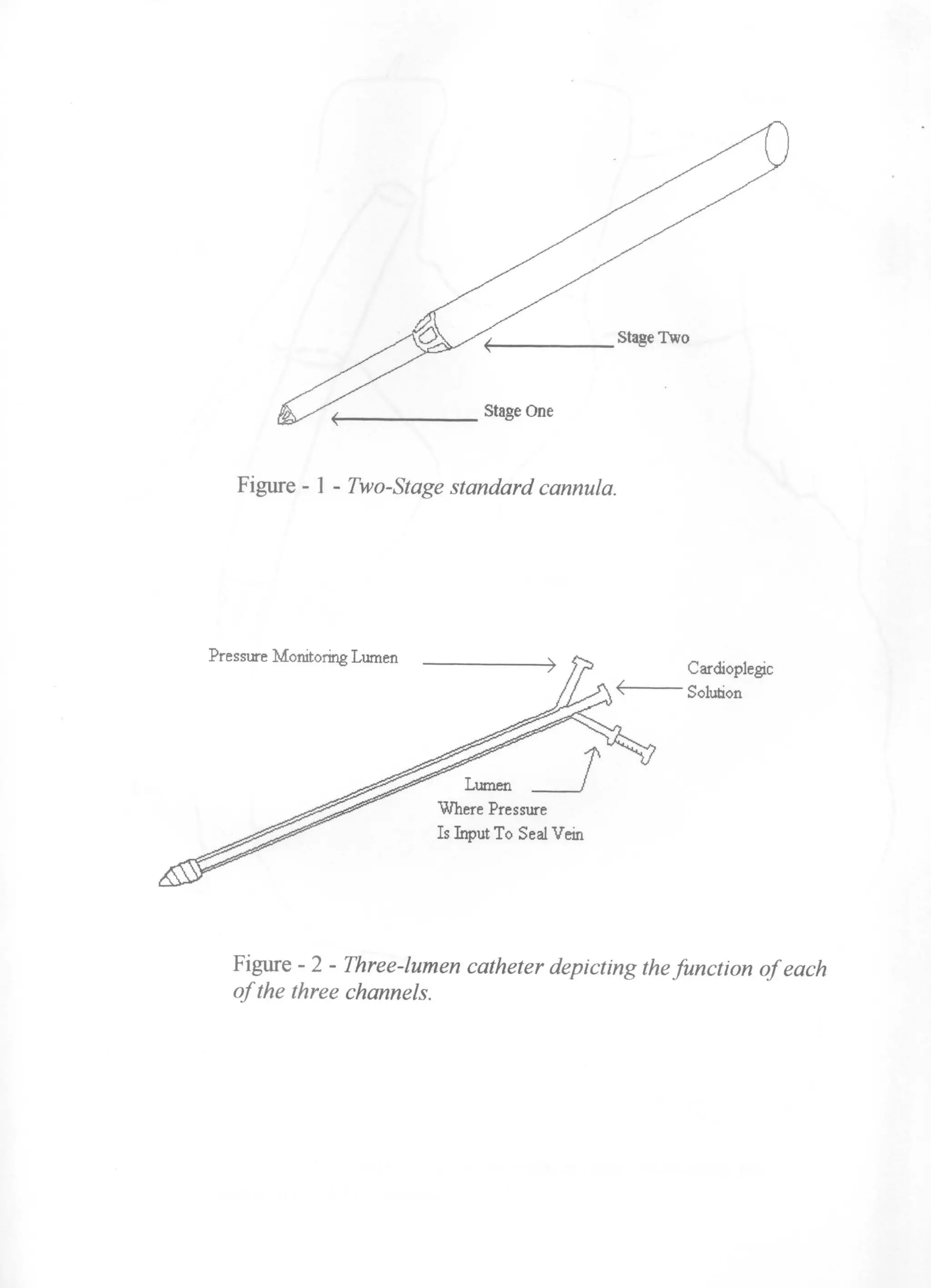 Device to Allow Alternative Method of Retrograde Cardioplegia Injection