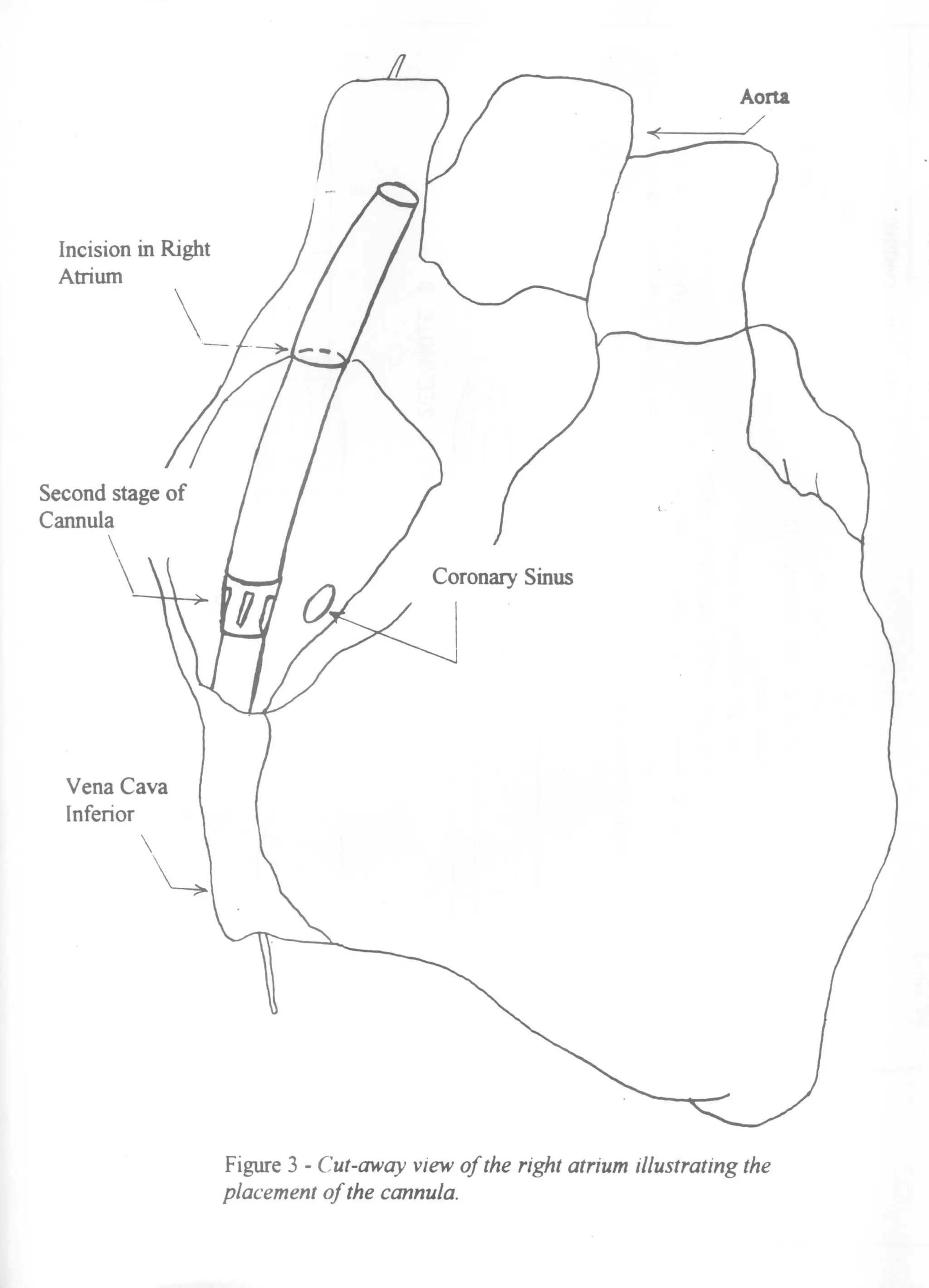 Device to Allow Alternative Method of Retrograde Cardioplegia Injection