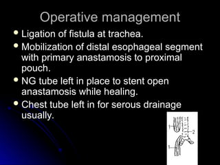 Operative management
Operative management
 Ligation of fistula at trachea.
Ligation of fistula at trachea.
 Mobilization of distal esophageal segment
Mobilization of distal esophageal segment
with primary anastamosis to proximal
with primary anastamosis to proximal
pouch.
pouch.
 NG tube left in place to stent open
NG tube left in place to stent open
anastamosis while healing.
anastamosis while healing.
 Chest tube left in for serous drainage
Chest tube left in for serous drainage
usually.
usually.
 