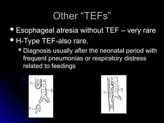Other “TEFs”
Other “TEFs”
 Esophageal atresia without TEF – very rare
Esophageal atresia without TEF – very rare
 H-Type TEF-also rare.
H-Type TEF-also rare.
Diagnosis usually after the neonatal period with
Diagnosis usually after the neonatal period with
frequent pneumonias or respiratory distress
frequent pneumonias or respiratory distress
related to feedings
related to feedings
 