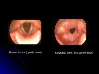 Normal Larynx (upside down) Laryngeal Web (also upside down)
 