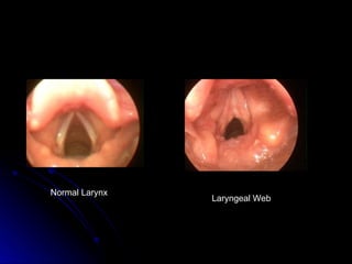 Normal Larynx
Laryngeal Web
 