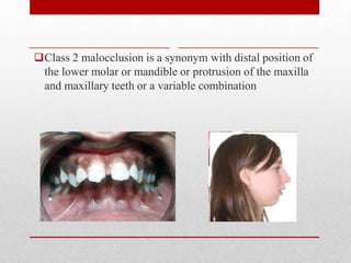 Class 2 malocclusion is a synonym with distal position of
the lower molar or mandible or protrusion of the maxilla
and maxillary teeth or a variable combination
 
