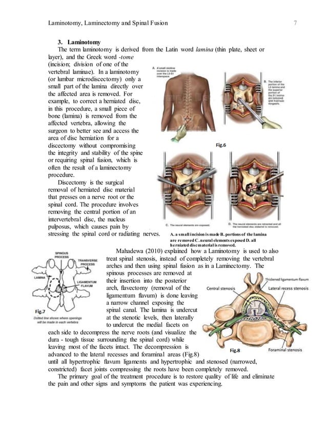 Breaking Down and Understanding Laminotomy, Laminectomy & Spinal Fusion