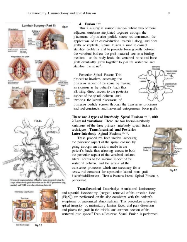 Breaking Down and Understanding Laminotomy, Laminectomy