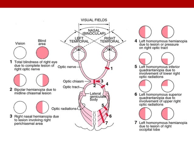 Vision Deficits Post Stroke In Service Vision Deficits Post Stroke In Service