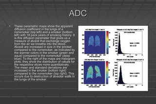 ADCADC
• These parametric maps show the apparentThese parametric maps show the apparent
diffusion coefficient in the lungs of adiffusion coefficient in the lungs of a
nonsmoker (top left) and a smoker (bottomnonsmoker (top left) and a smoker (bottom
left) with 18 pack years of smoking history. Itleft) with 18 pack years of smoking history. It
is this diffusion parameter that gives us ais this diffusion parameter that gives us a
measure of alveoli that exchange oxygenmeasure of alveoli that exchange oxygen
from the air we breathe into the blood.from the air we breathe into the blood.
Alveoli are increased in size in the smokerAlveoli are increased in size in the smoker
compared to the nonsmoker, as indicated bycompared to the nonsmoker, as indicated by
the warmer colors in the smoker (green andthe warmer colors in the smoker (green and
aqua) compared to the nonsmoker (deepaqua) compared to the nonsmoker (deep
blue). To the right of the maps are histogramblue). To the right of the maps are histogram
plots; they show the distribution of values forplots; they show the distribution of values for
the respective slices more quantitatively.the respective slices more quantitatively.
The mean and standard deviations areThe mean and standard deviations are
increased in the smoker (bottom right)increased in the smoker (bottom right)
compared to the nonsmoker (top right). Thiscompared to the nonsmoker (top right). This
occurs due to destruction of alveolar walls inoccurs due to destruction of alveolar walls in
the lungs of the smoker.the lungs of the smoker.
 