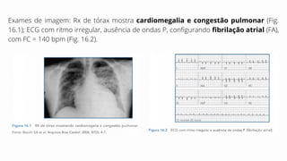 Exames de imagem: Rx de tórax mostra cardiomegalia e congestão pulmonar (Fig.
16.1); ECG com ritmo irregular, ausência de ondas P, configurando fibrilação atrial (FA),
com FC = 140 bpm (Fig. 16.2).
 