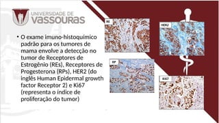 • O exame imuno-histoquímico
padrão para os tumores de
mama envolve a detecção no
tumor de Receptores de
Estrogênio (REs), Receptores de
Progesterona (RPs), HER2 (do
inglês Human Epidermal growth
factor Receptor 2) e Ki67
(representa o índice de
proliferação do tumor)
 