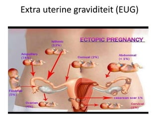 Extra uterine graviditeit (EUG)
 