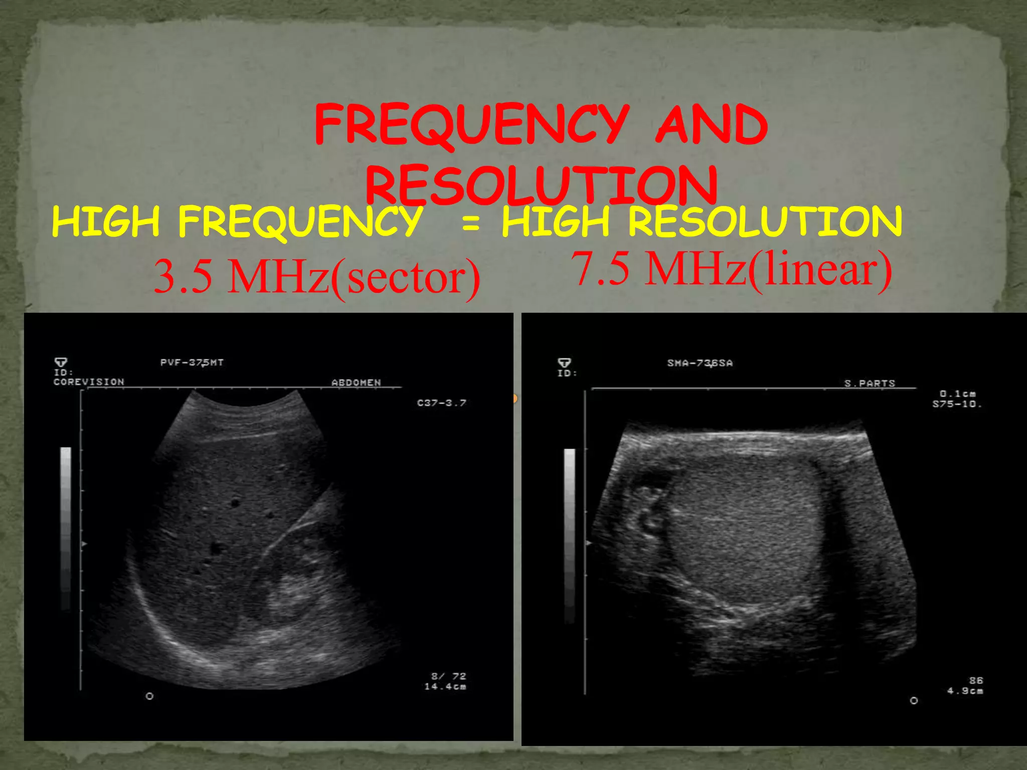 FREQUENCY AND
            RESOLUTION
HIGH FREQUENCY = HIGH RESOLUTION
   3.5 MHz(sector)   7.5 MHz(linear)
 