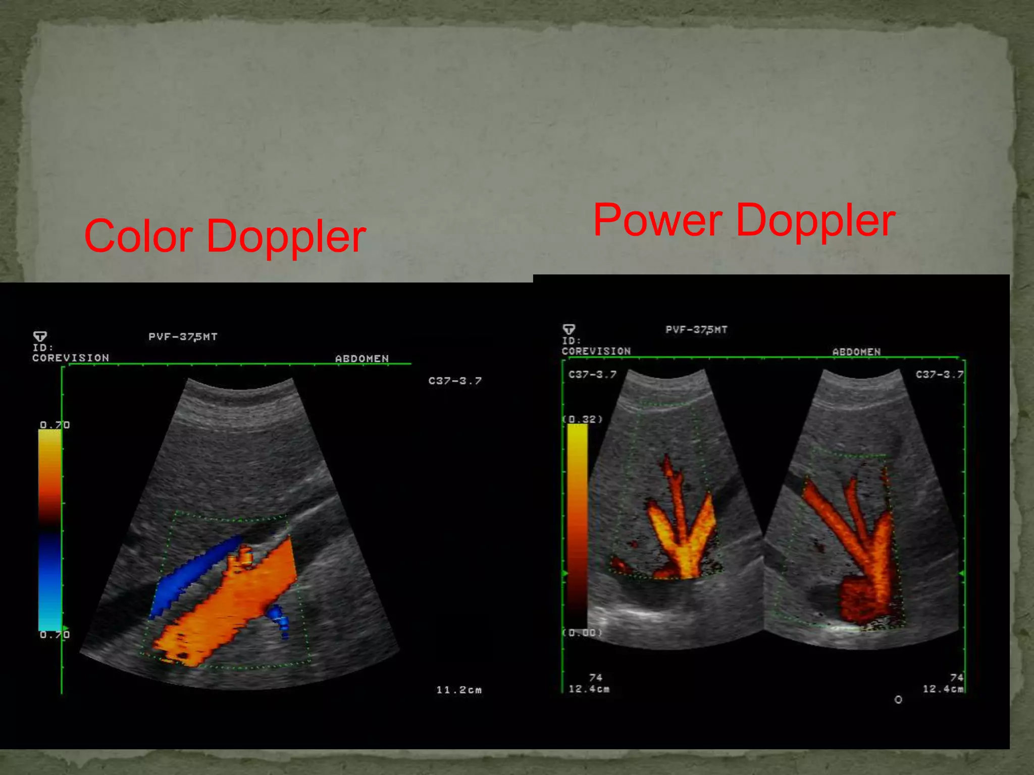 Color Doppler   Power Doppler
 