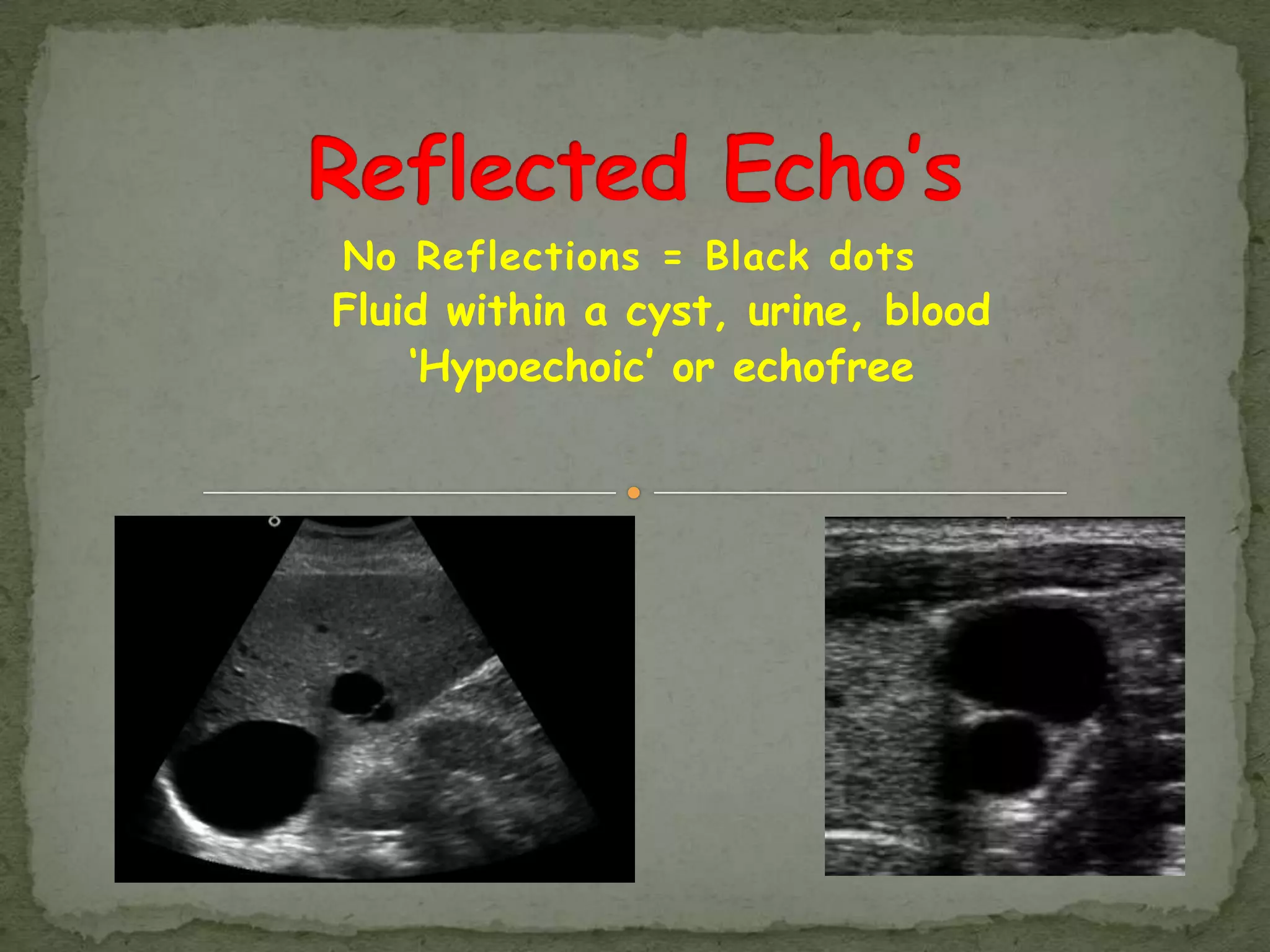 No Reflections = Black dots
Fluid within a cyst, urine, blood
    „Hypoechoic‟ or echofree
 