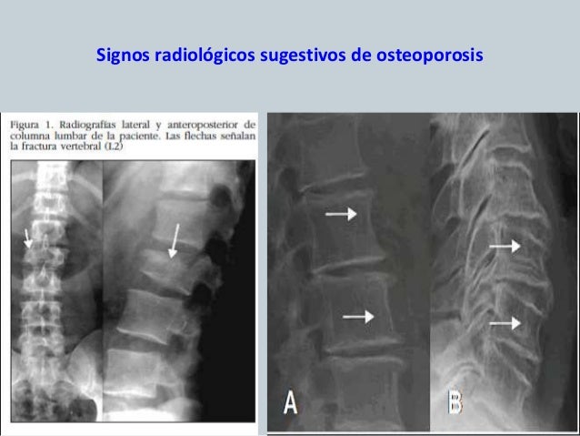 Osteoporosis