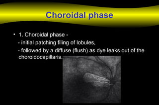 Choroidal phase
• 1. Choroidal phase -
- initial patching filing of lobules,
- followed by a diffuse (flush) as dye leaks out of the
choroidocapillaris.
 