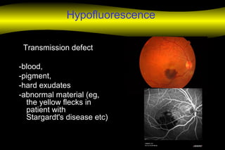 Hypofluorescence
Transmission defect
-blood,
-pigment,
-hard exudates
-abnormal material (eg,
the yellow flecks in
patient with
Stargardt's disease etc)
 