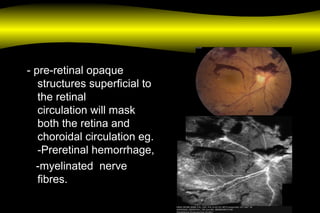 - pre-retinal opaque
structures superficial to
the retinal
circulation will mask
both the retina and
choroidal circulation eg.
-Preretinal hemorrhage,
-myelinated nerve
fibres.
 