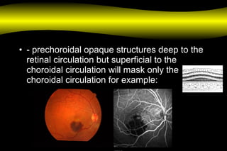• - prechoroidal opaque structures deep to the
retinal circulation but superficial to the
choroidal circulation will mask only the
choroidal circulation for example:
 