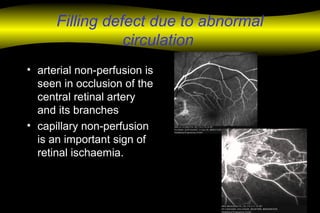 Filling defect due to abnormal
circulation
• arterial non-perfusion is
seen in occlusion of the
central retinal artery
and its branches
• capillary non-perfusion
is an important sign of
retinal ischaemia.
 