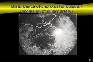 46
Disturbance of choroidal circulation
(occlusion of ciliary artery)
 