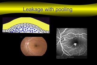 Leakage with pooling
 