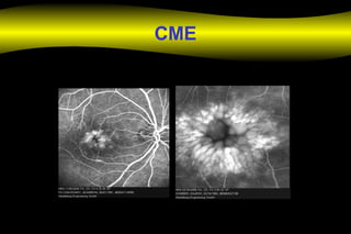CME
 