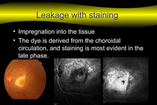 Leakage with staining
• Impregnation into the tissue
• The dye is derived from the choroidal
circulation, and staining is most evident in the
late phase.
 