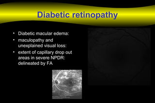 Diabetic retinopathy
• Diabetic macular edema:
• maculopathy and
unexplained visual loss:
• extent of capillary drop out
areas in severe NPDR:
delineated by FA
 