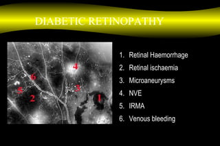 1. Retinal Haemorrhage
2. Retinal ischaemia
3. Microaneurysms
4. NVE
5. IRMA
6. Venous bleeding
DIABETIC RETINOPATHY
 