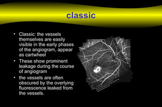 classic
• Classic: the vessels
themselves are easily
visible in the early phases
of the angiogram, appear
as cartwheel
• These show prominent
leakage during the course
of angiogram
• the vessels are often
obscured by the overlying
fluorescence leaked from
the vessels.
 