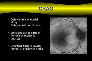 CRAO
• Delay in retinal arterial
filling
Delay in A-V transit time
• complete lack of filling of
the retinal arteries is
unusual
• Choroidal filling is usually
normal or a delay of 5 secs
 