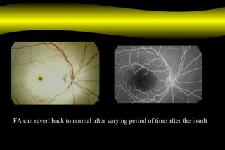 FA can revert back to normal after varying period of time after the insultFA can revert back to normal after varying period of time after the insult
 