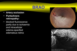 BRAO
• Artery occlusion
• Purtschners
retinopathy-
• blocked fluoroscence
partly due to ischaemia
and intracellular
edema-opacified
edematous retina
 