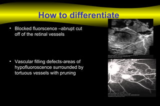 How to differentiate
• Blocked fluorscence –abrupt cut
off of the retinal vessels
• Vascular filling defects-areas of
hypofluoroscence surrounded by
tortuous vessels with pruning
 