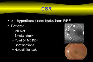 CSR
• ≥ 1 hyperfluorescent leaks from RPE
• Pattern:
– Ink-blot
– Smoke-stack
– Point (< 1/5 DD)
– Combinations
– No definite leak
 