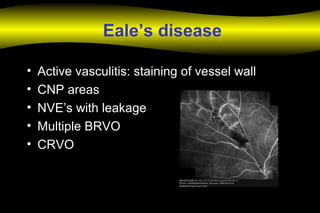 Eale’s disease
• Active vasculitis: staining of vessel wall
• CNP areas
• NVE’s with leakage
• Multiple BRVO
• CRVO
 