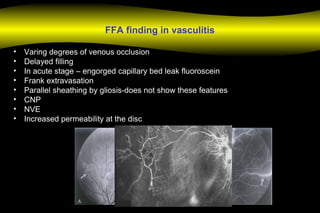 FFA finding in vasculitis
• Varing degrees of venous occlusion
• Delayed filling
• In acute stage – engorged capillary bed leak fluoroscein
• Frank extravasation
• Parallel sheathing by gliosis-does not show these features
• CNP
• NVE
• Increased permeability at the disc
 