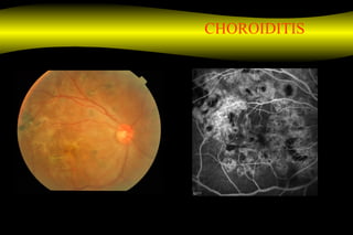 CHOROIDITIS
 
