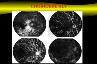 CHORIOEREMIA
 