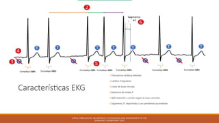 Características EKG
1.Frecuencia cardíaca elevada
2.Latidos irregulares
3.Línea de base vibrada
4.Ausencia de ondas P
5.QRS estrecho o ancho según el caso concreto.
6.Segmento ST deprimido y con pendiente ascendente
ATRIAL FIBRILLATION: AN APPROACH TO DIAGNOSIS AND MANAGEMENT IN THE
EMERGENCY DEPARTMENT 2021
 