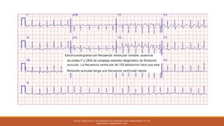 ATRIAL FIBRILLATION: AN APPROACH TO DIAGNOSIS AND MANAGEMENT IN THE
EMERGENCY DEPARTMENT 2021
 