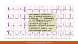 ATRIAL FIBRILLATION: AN APPROACH TO DIAGNOSIS AND MANAGEMENT IN THE
EMERGENCY DEPARTMENT 2021
Electrocardiograma que demuestra una
taquicardia regular de complejo estrecho
con conducción 2:1. La frecuencia auricular
está en los 300 segundos y la frecuencia
ventricular es de 162 latidos/min. Una
frecuencia ventricular de 150 +/- 20
latidos/min es una frecuencia característica
del aleteo auricular. En este
electrocardiograma también se pueden
observar ondas P en “diente de sierra”.
 