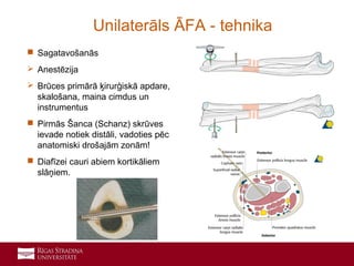 15
 Sagatavošanās
 Anestēzija
 Brūces primārā ķirurģiskā apdare,
skalošana, maina cimdus un
instrumentus
 Pirmās Šanca (Schanz) skrūves
ievade notiek distāli, vadoties pēc
anatomiski drošajām zonām!
 Diafīzei cauri abiem kortikāliem
slāņiem.
Unilaterāls ĀFA - tehnika
 