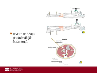 16
 Ievieto skrūves
proksimālajā
fragmentā
 