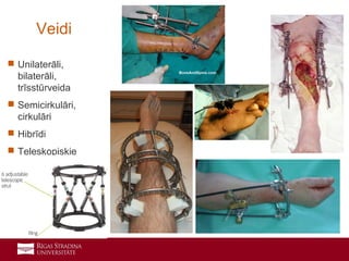 5
 Unilaterāli,
bilaterāli,
trīsstūrveida
 Semicirkulāri,
cirkulāri
 Hibrīdi
 Teleskopiskie
Veidi
 