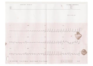 Fibrilación Auricular