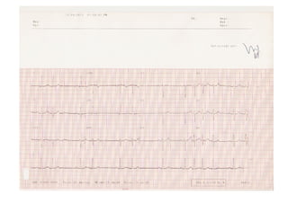 Fibrilación Auricular